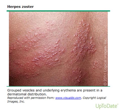 Herpes Zoster Flashcards Quizlet