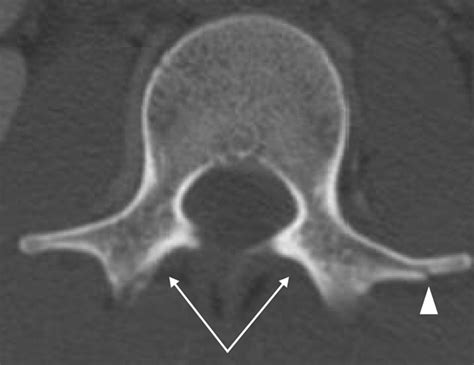 Chance Type Fractures Of The Thoracolumbar Spine Imaging Analysis In