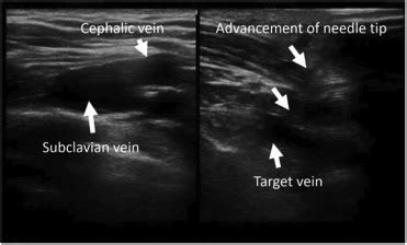 Real Time Ultrasound Guided Puncture Of Subclavian Vein For Chemo Port