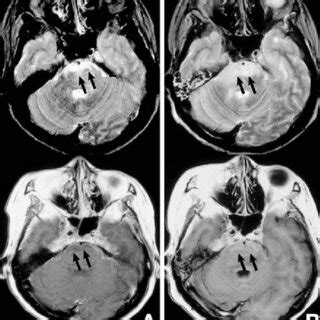 A B Axial T Weighted Magnetic Resonance Mr Images With