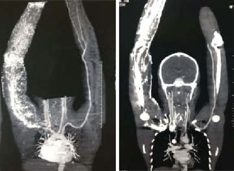 Ct Venography Showed Bilateral Brachiocephalic Vein Innominate Vein