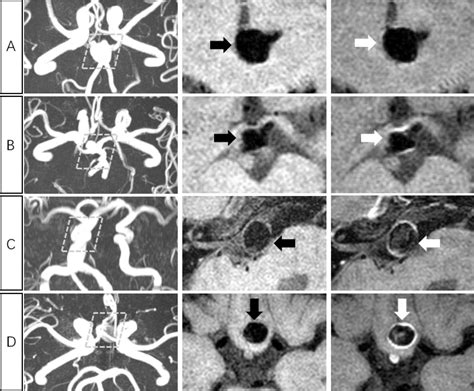 Associations Between Haemodynamics And Wall Enhancement Of Intracranial