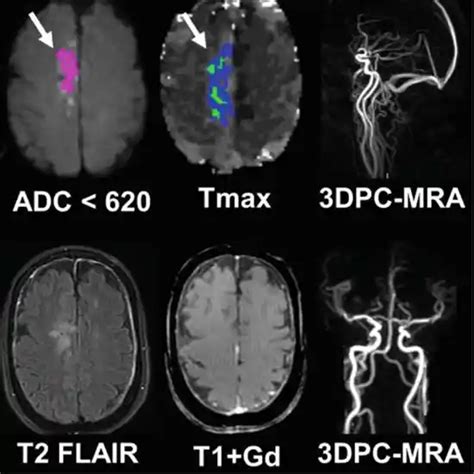 MRI Screening of Brain + DWI + MRA + Neck Test Near You in Delhi | Book ...