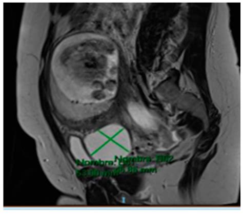 Medicina Free Full Text Advanced Ovarian Cancer During Pregnancy