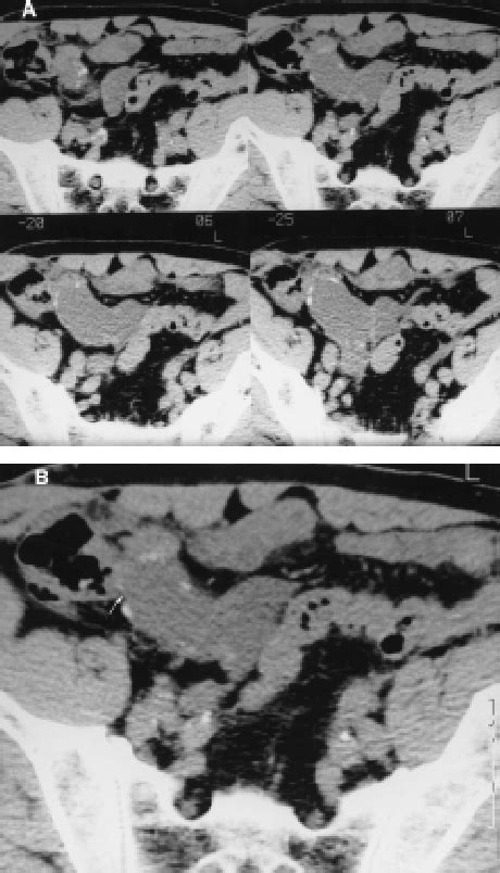 A Axial Ct Scans With Mm Slice Thickness Which Clearly Reveals A