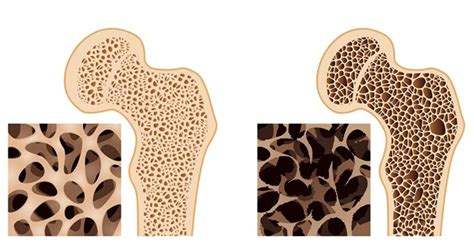 Osteoporose Prevenção Diagnóstico e Tratamento