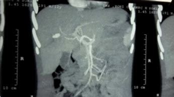 Spontaneous Resolution Of Post Traumatic Hepatic Artery Pseudoaneurysm