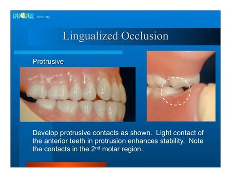 Complete Dentures 16occlusal Schemes Lingualized Occlusion