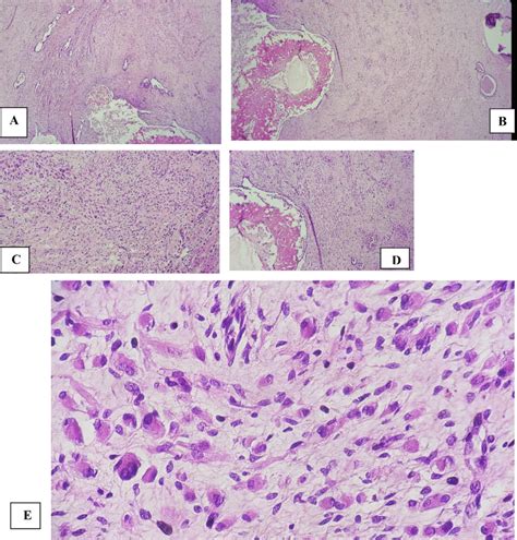 A Wilms Tumor Two Component Seen Here Epithelial And Stromal