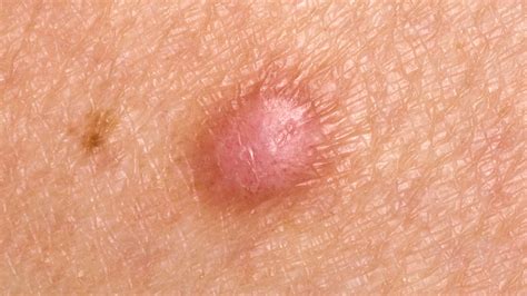 What Are Small Bumps On Skin 23 Pictures Of Skin Rashes