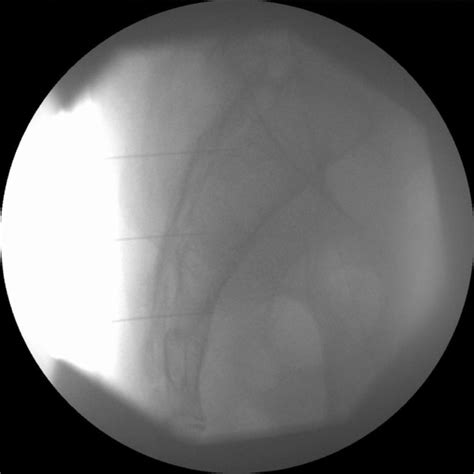 Lateral Fluoroscopic View Of The Sacrum Showing Three Separate 25 Gauge