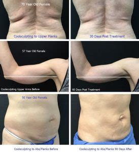 Atlanta Coolsculpting Before After Photos