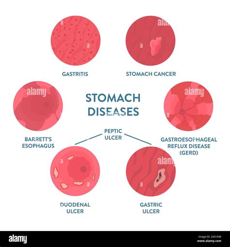 Stomach Diseases Hi Res Stock Photography And Images Alamy