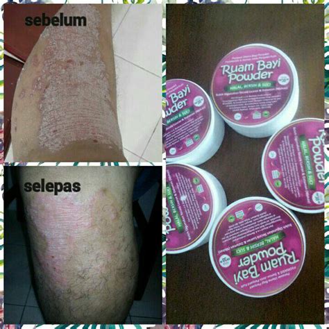 Penawar Psoriasis Eczema Ruam Bayi And Semua Jenis Penyakit Kulit