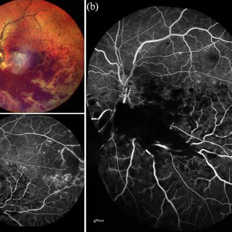 A Typical Case Of Irvan Syndrome A Color Fundus Image Showing Disk