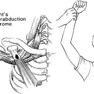 Pdf Clinical Brief Neurogenic Thoracic Outlet Syndrome