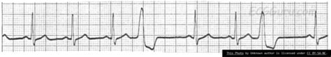 Ventricular Dysrhythmias Flashcards Quizlet