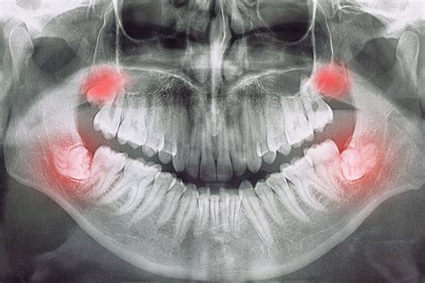 Silent Inflammation Biologische Zahnmedizin Hamburg