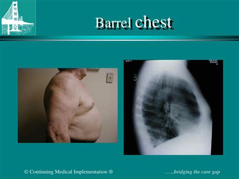 Barrel Chest