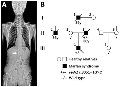 Genes Free Full Text Fbn1 Splice Altering Mutations In Marfan