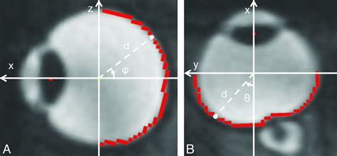 Automated Quantitation Of The Posterior Scleral Flattening And Optic