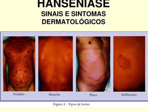 Quais Os Sintomas Da Hanseníase - Sinais E Sintomas Da Hanseníase – SDYEM