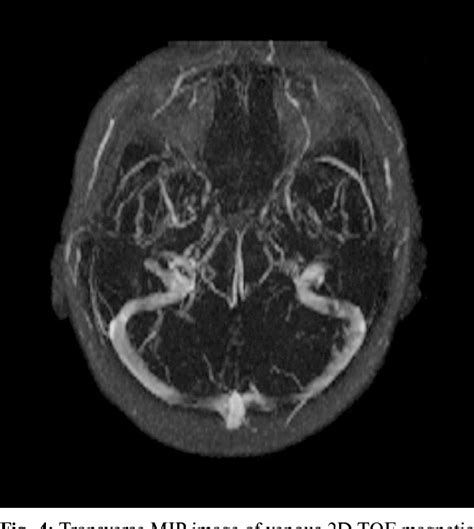 Figure From Cerebral Venous Thrombosis After A Cesarean Delivery