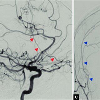 Cerebral angiography showing (a) left ACA pseudoaneurysm, and tumor ...