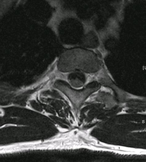 Spine Mr Shows Spinal Subdural Hemorrhage Anterior To The Spinal Cord