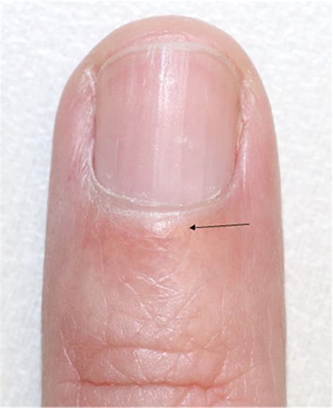 Nail Fold Infarcts