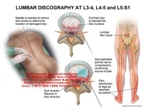 Lumbar Discography At L3 4 L4 5 And Ls 1