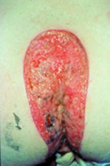 Infected Pilonidal Abscess