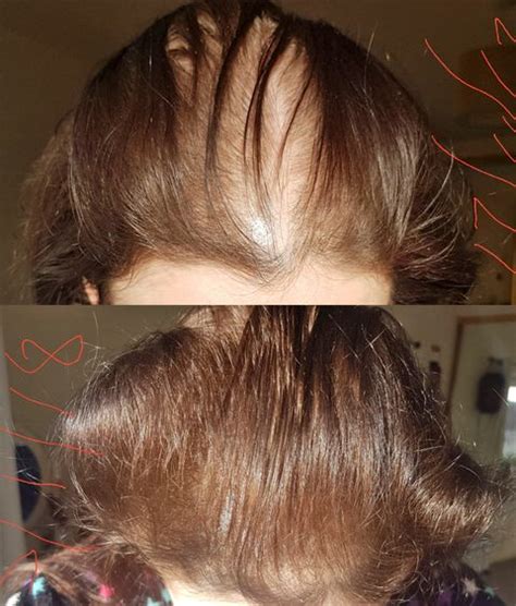 How Rogaine Regrew This Woman's Thinning Hair in 6 Weeks - Rogaine ...