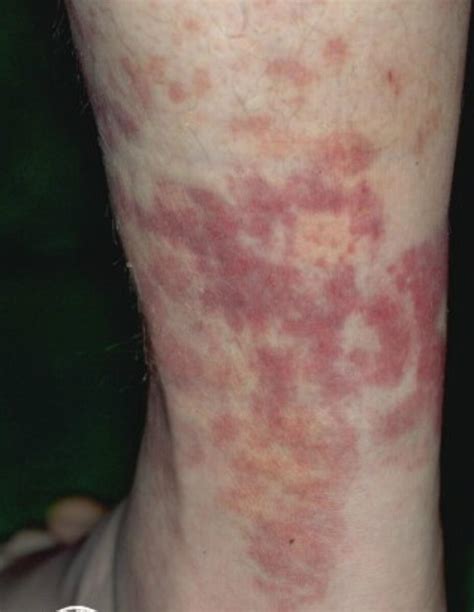 Urticaria Vasculitis Urticaria Vasculitis Natural Treatment Images