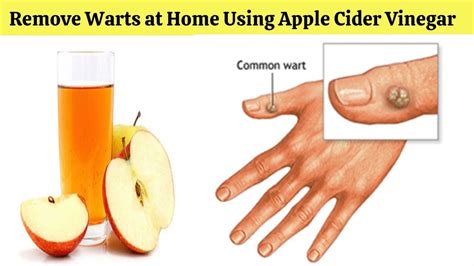 How To Remove Warts At Home Using Apple Cider Vinegarremove Warts At