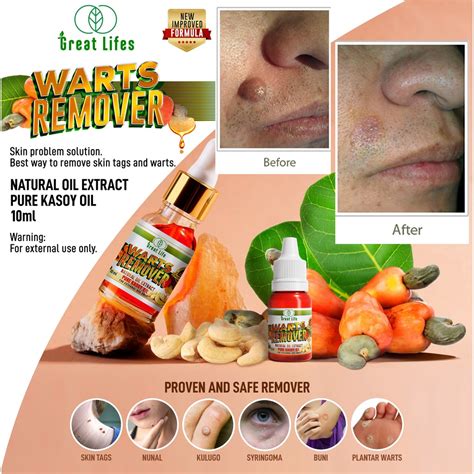 Original Warts Remover Skin Problem Solution 100 Pure Kasoy Oil