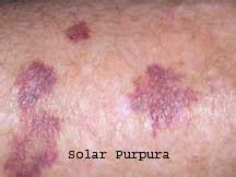 Orlando Solar Purpura Treatment | OrlandoSkinDoc