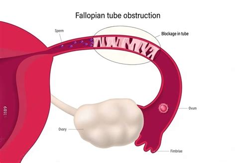 Steps To Getting Pregnant With Blocked Fallopian Tubes