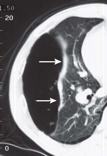 34 Relaxation Atelectasis Radiology Key