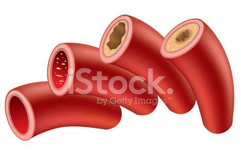 Illustrates The Progression Of Atherosclerosis In Cvd Patients Stock