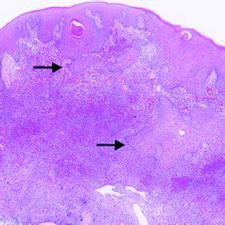 A Low Power H E Stained Section Showing A Tissue Fragment Surfaced By