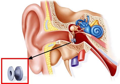 Myringotomy Procedure Myringotomy Tubes Placement Risks And Recovery