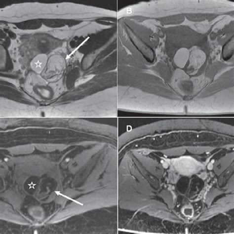 Ovarian Torsion Caused By A Mature Teratoma Pelvic Mri The Left Ovary