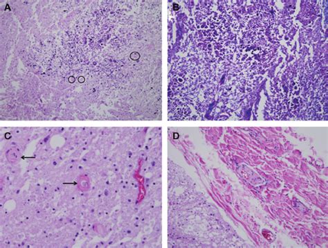 Histopathology Of Spinal Cord Showing Spheroids A Demyelination B