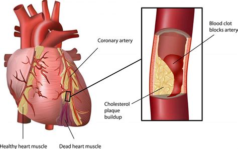 What is a Thrombus? (with pictures)