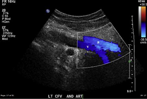 Venous Duplex Doppler Examination Both The Left Common Femoral Vein