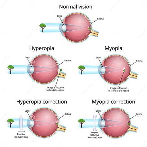 Vision Problems And Their Correction Myopia And Hyperopia Stock Illustration Illustration Of