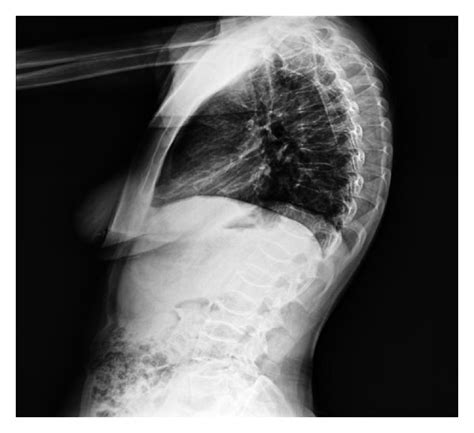 Lateral Thoracolumbar X Ray Loss Of Height In Vertebrae And Biconcave