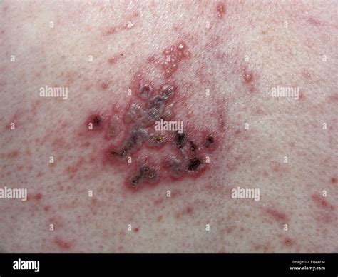 Herpes körper Fotos und Bildmaterial in hoher Auflösung Alamy