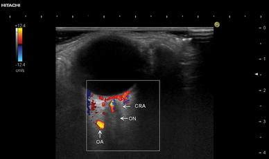 Ultrasound Image Of A Ophthalmic Artery Oa Central Retinal Artery